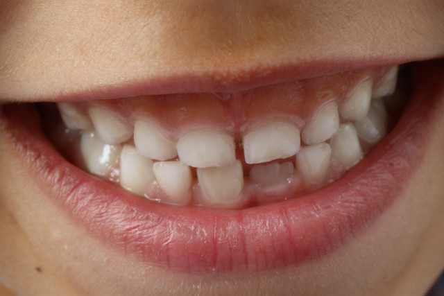 Quand programmer la première visite chez le dentiste d’un enfant